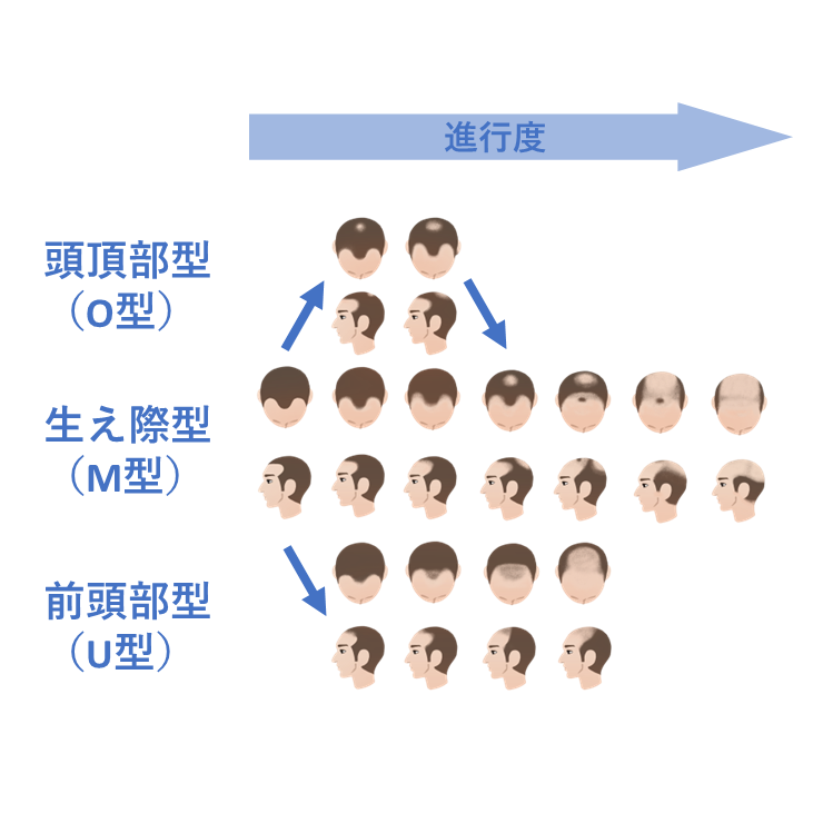 カークランド・ミノキシジル